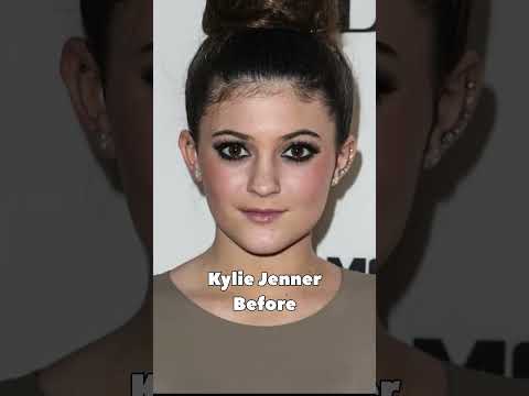 KYLIE JENNER before and after her plastic surgery #trending