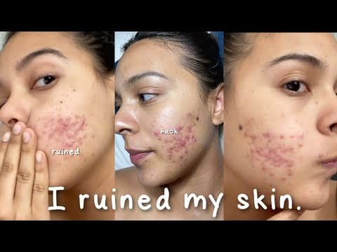 I Ruined My Skin with this Beauty Hack… #shorts #skincare