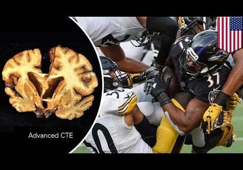 Brain disease CTE found in 99% of NFL players, latest brain study shows &#8211; TomoNews