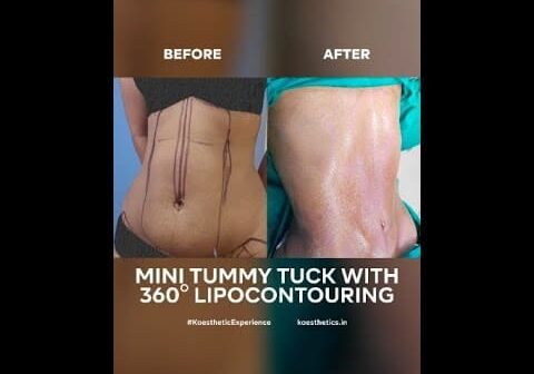 Before and After of Mini Tummy Tuck with 360 degree Lipocontouring #shorts