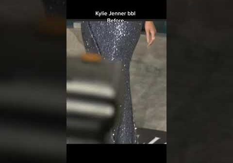 Kylie Jenner BBl Removal before and after